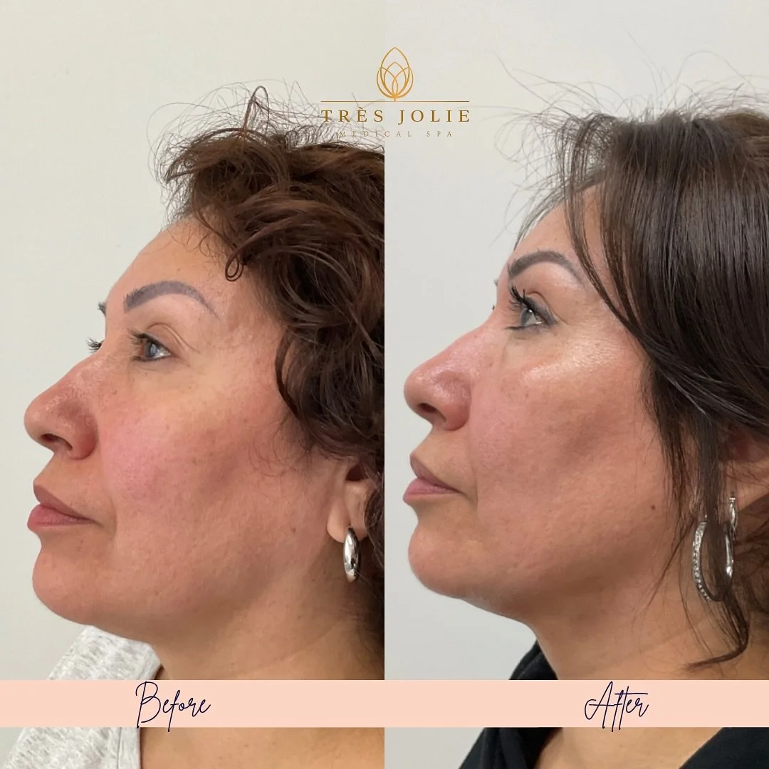 2 months of transformation with @tresjoliebydrperez! 🤍✨
Our beautiful patients results are just 2 months apart— after a personalized treatment plan that included: Botox 💉 to soften expression lines and prevent deeper wrinkles. 
Laser Peel &