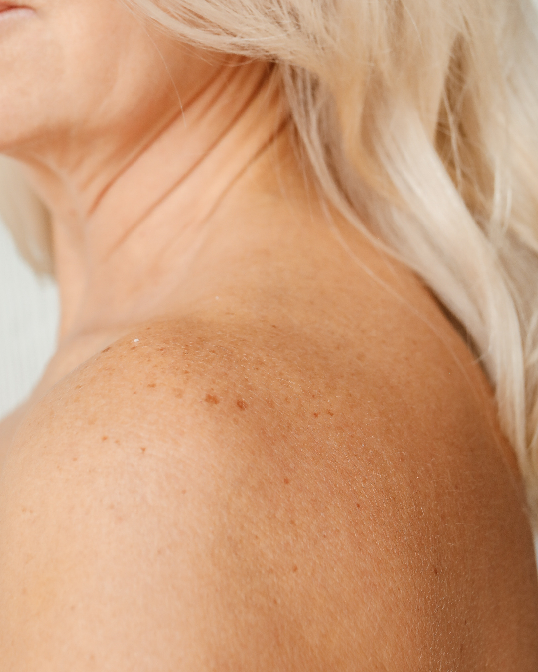 Laser for pigmentation on armpits and back of neck and groin