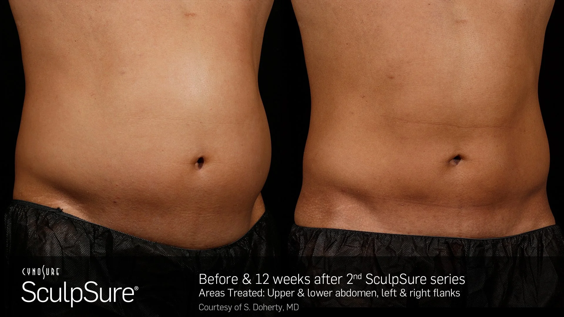 SculpSureBA_SidebySide_Male1.2.jpg