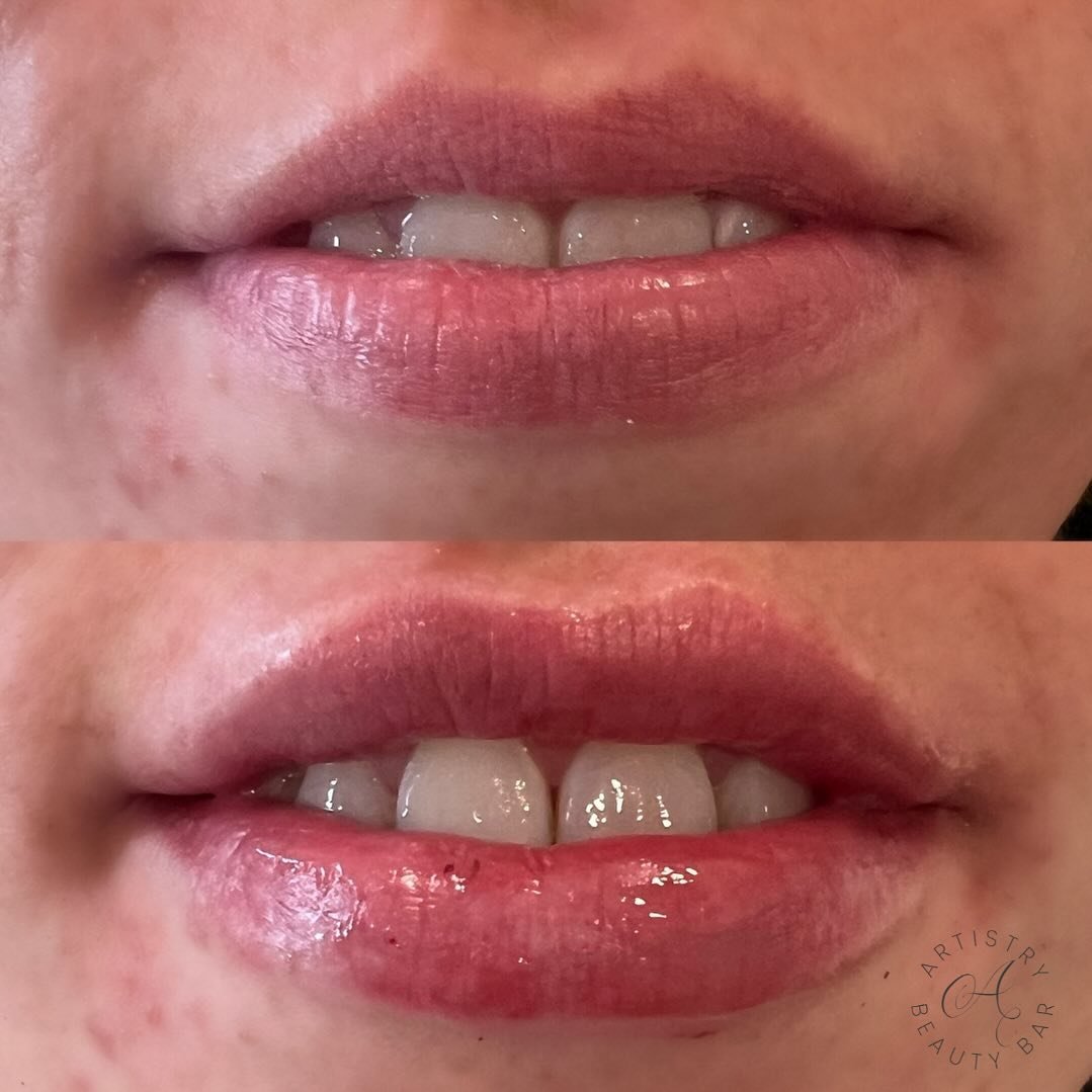 We always hear clients say &ldquo;I just want my lips to look natural!&rdquo; WE GOT YOU! Dr. White &amp; Dr. Matin provide the most natural lip enchancements, making sure to give you the results you are looking for 💋💋💋 

BOOK &mdash; 334.209.0499