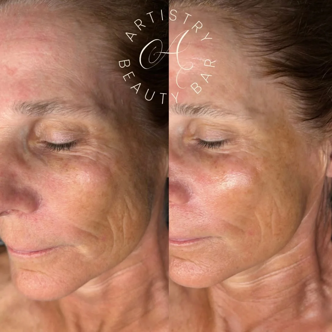 ✨ Real results that speak for themselves! ✨

After seeing our post featuring the Glo2 Deluxe Facial with the ExoFirm Pod, this client decided to book the same treatment for herself &mdash; and we&rsquo;re so glad she did! 🤍

Look at the visible impr