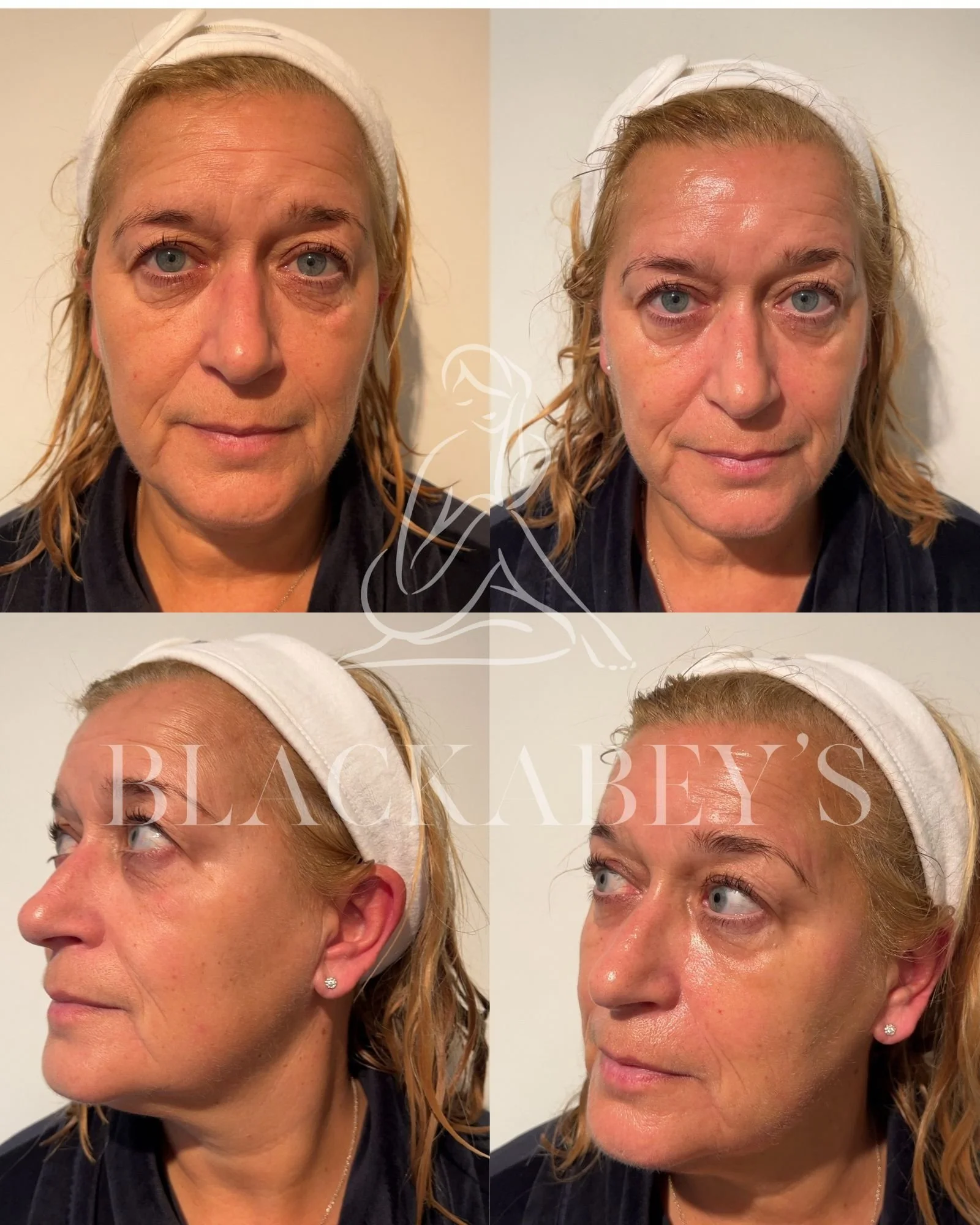 ageing skin, sun exposure, dry skin