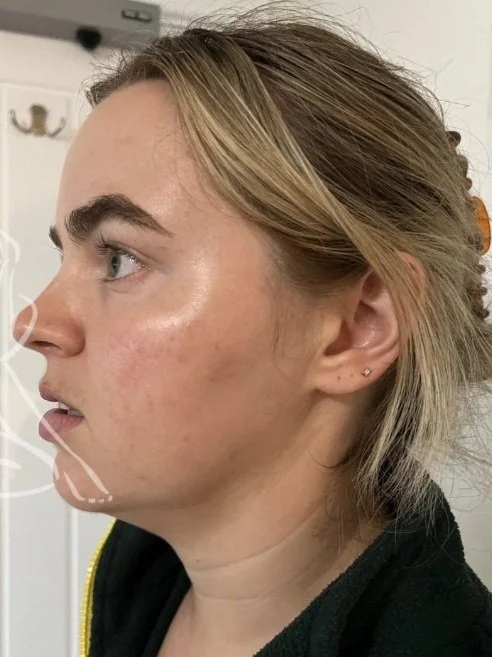 Elyse's Happy Skin Journey