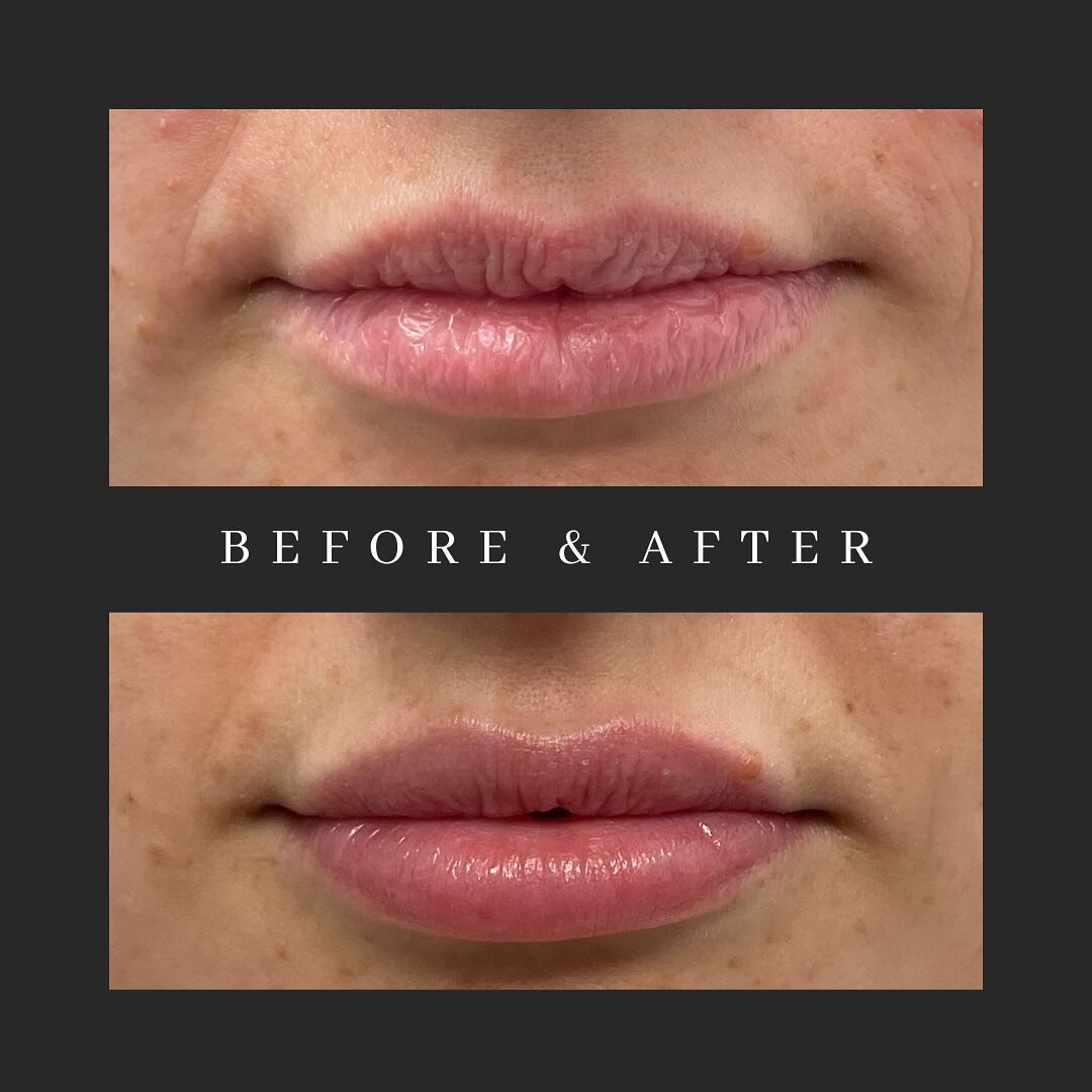 Let&rsquo;s talk lip filler 👄

The &bull;goal&bull; is to enhance your natural beauty by adding a little volume and hydration into your unique lips. 

Injecting lips is not a one-size-fits-all skill. Each client gets injected a little differently ba