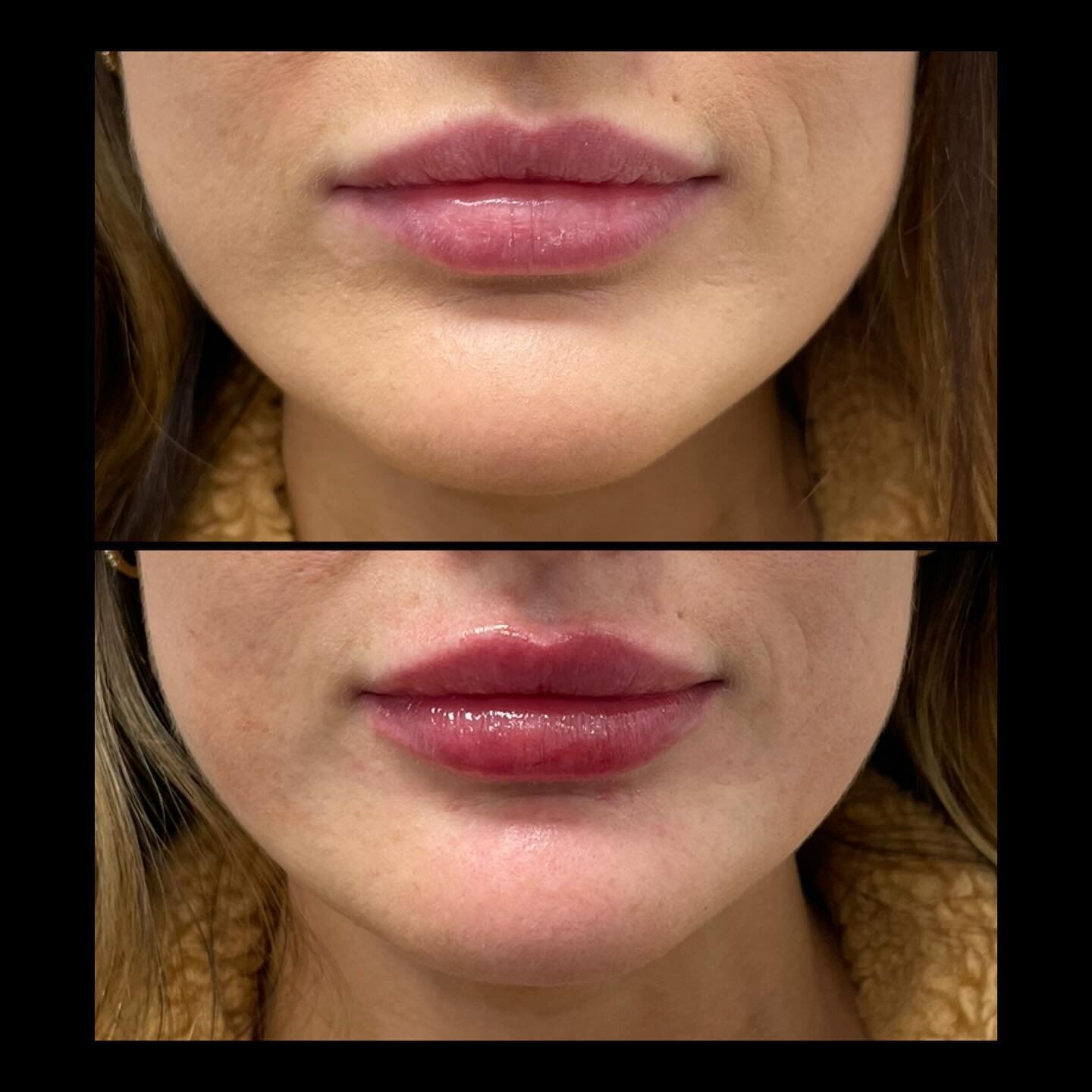 Mouth Monday 👄

The more I inject, the more I have such a strong appreciation for individualized beauty.

Everyone has such a different shape to their lips. No lip is the same and that is what makes it fun! I love adding a little volume to enhance e