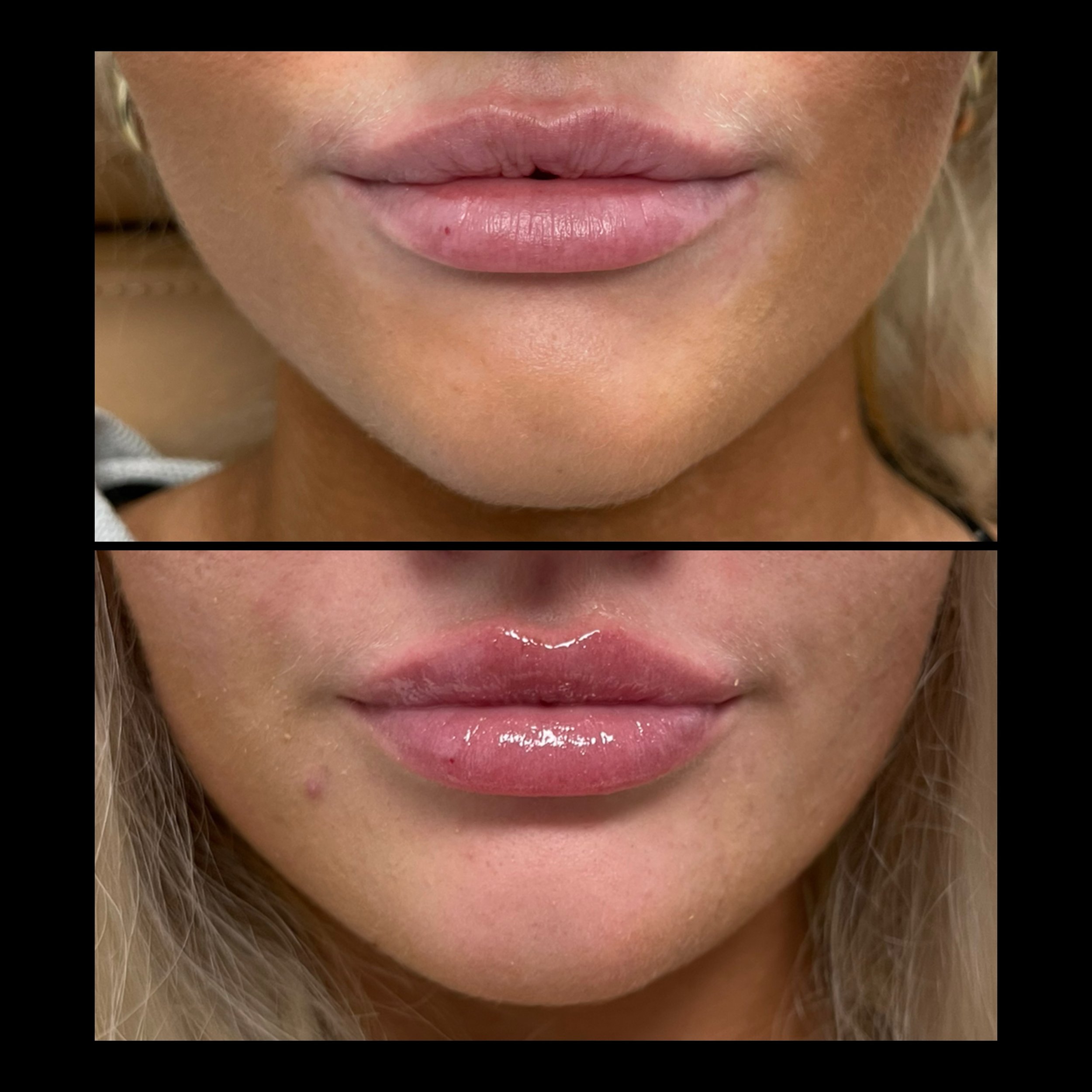 Before⇢2 weeks after 👄

We got those borders nice and sharp &amp; added a little hydration just in time for summer! ☀️

Reminder: This week &amp; next week I&rsquo;m offering $50 off ALL services! (Botox/dysport/jeuveau, filler, chemical peels and m