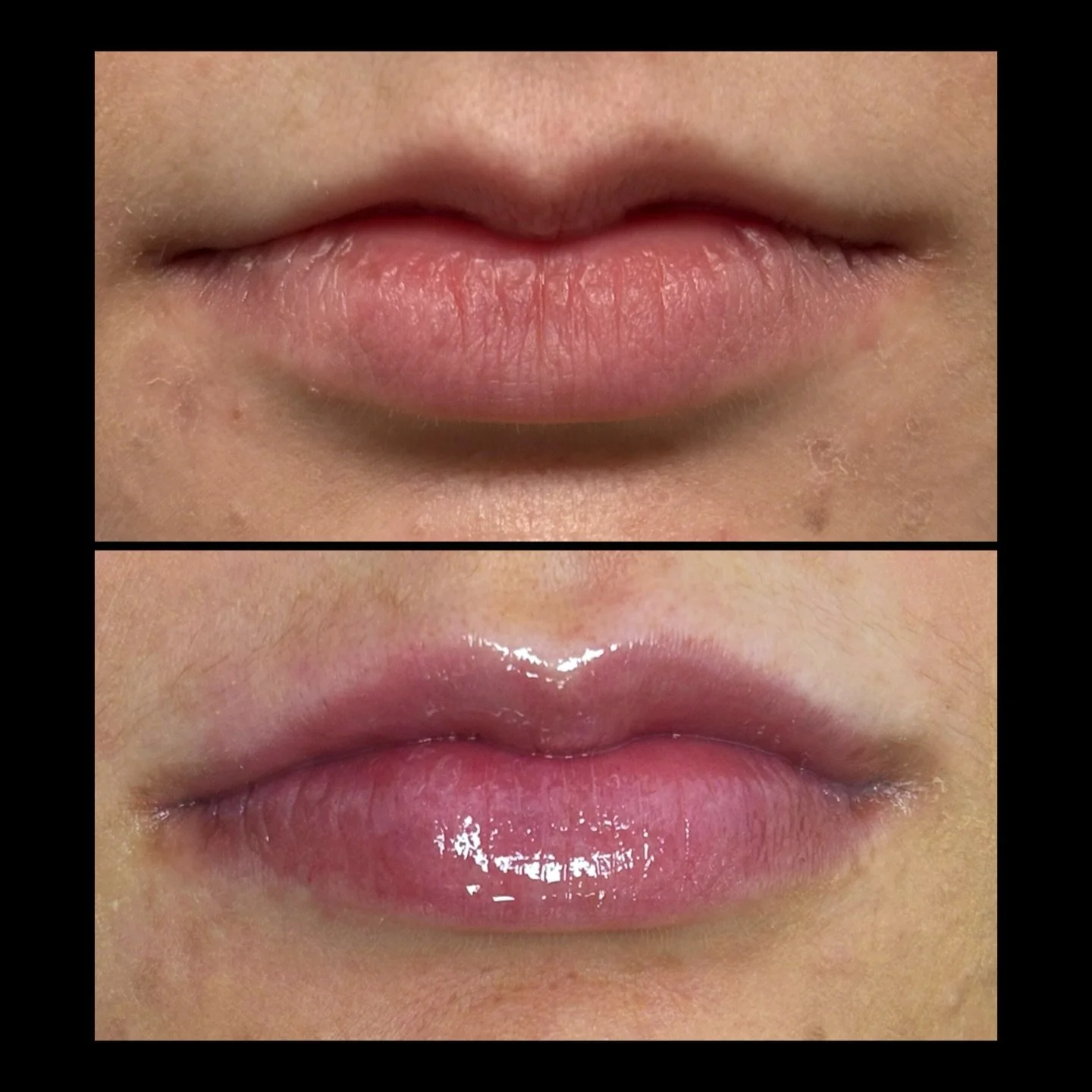 I&rsquo;m often asked if lips can be &lsquo;too small&rsquo; for filler &mdash; and the answer is no.

With smaller lips, we simply build slowly for the softest, most natural results.

This patient chose my Subtle Lip, using just over half a syringe.