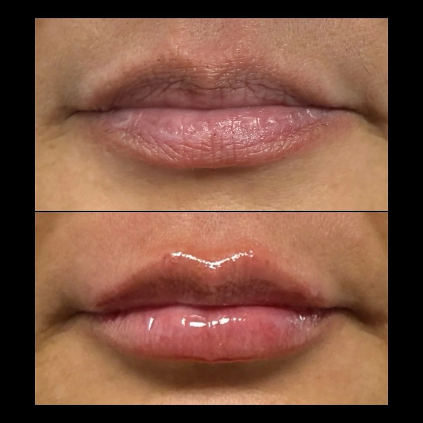 Hydrated. Plump. Crisp. 

It&rsquo;s amazing what just 1 syringe of lip filler can do 👄