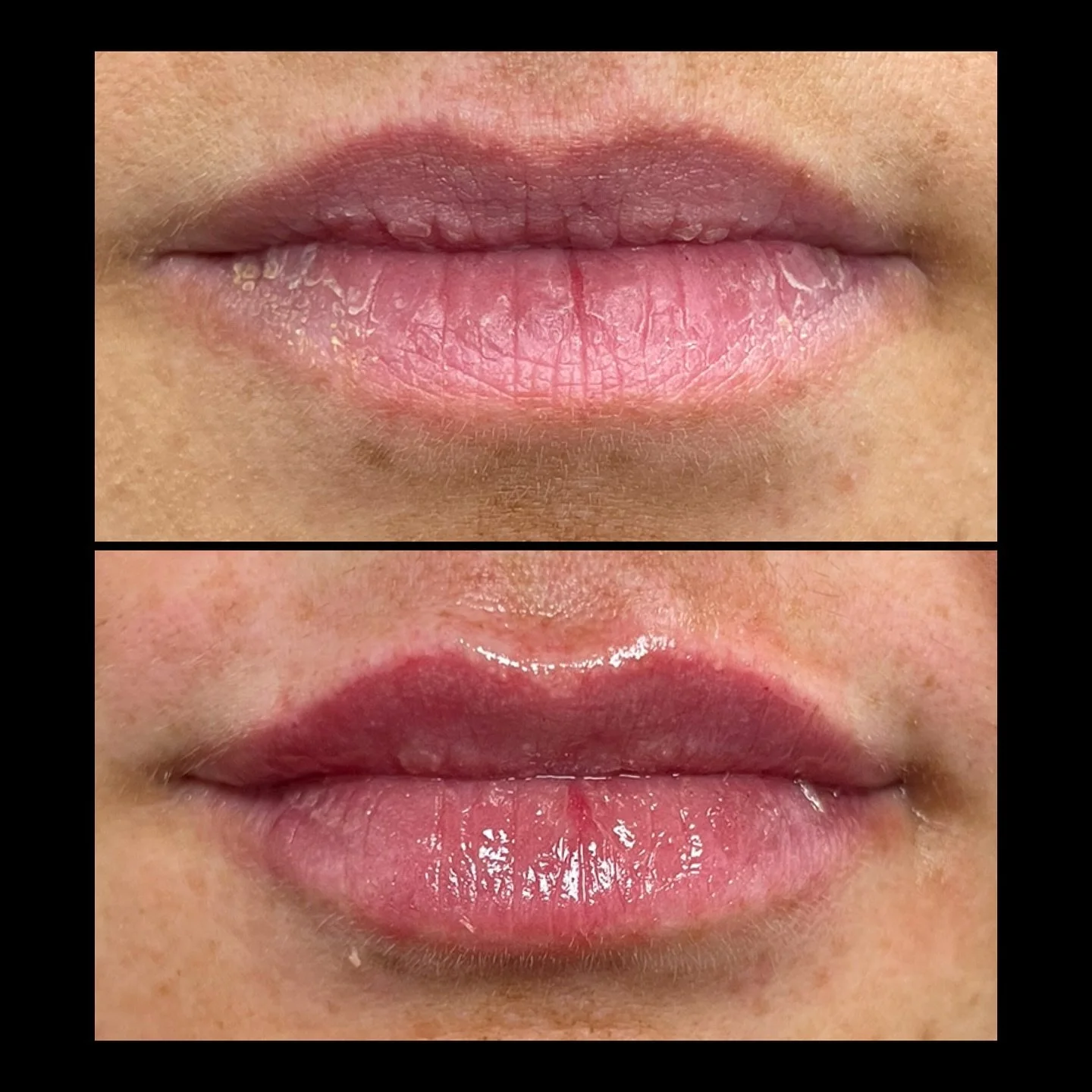 The Subtle Lip enhances the natural lip borders, adds hydration, and gently shapes for a soft, balanced look💋 

I only have one filler appointment left in May (May 30th at 10:30am) but June is right around the corner!! Let&rsquo;s get you summer rea