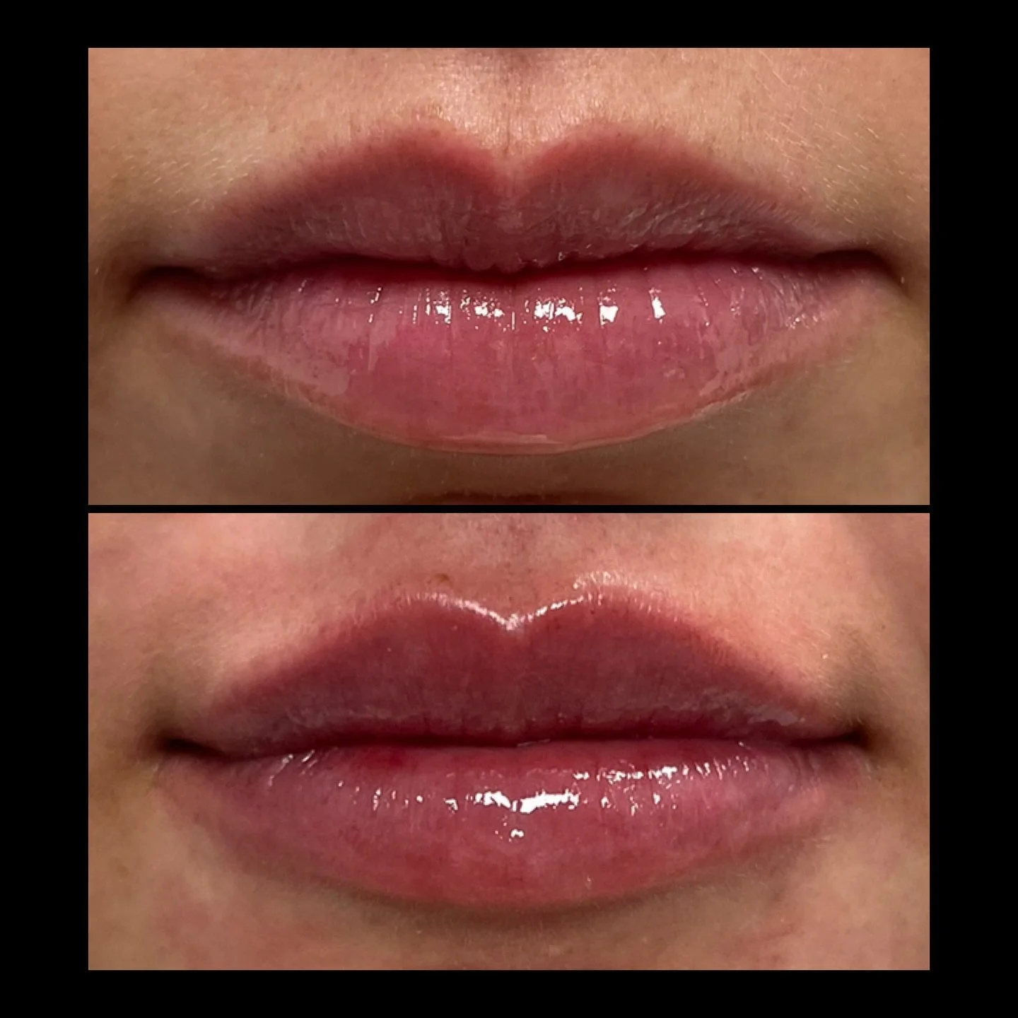 A subtle lip and a little chin pop! This beautiful result was achieved using just over 1 full syringe&mdash;1.2 mL of our signature lip technique&mdash;customized to enhance her natural beauty and balance her profile perfectly.