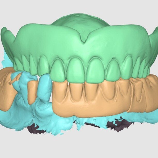 Our 3D scanner converts existing dental work into records...for planning and for the creation of a new comfortable denture.