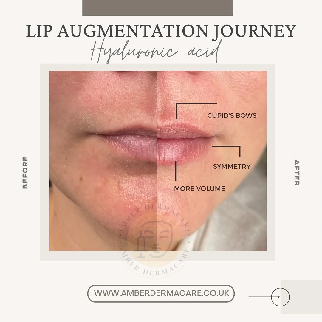 The Art of Delicate Lip Enhancement: Subtle yet Transformative Results

When it comes to enhancing your natural beauty, subtlety is key. At our clinic, we believe that lip enhancement should be about creating harmony and balance, not dramatic changes