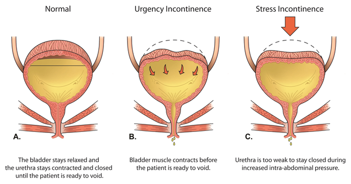 Urinary Incontinence — Pacific West Urology