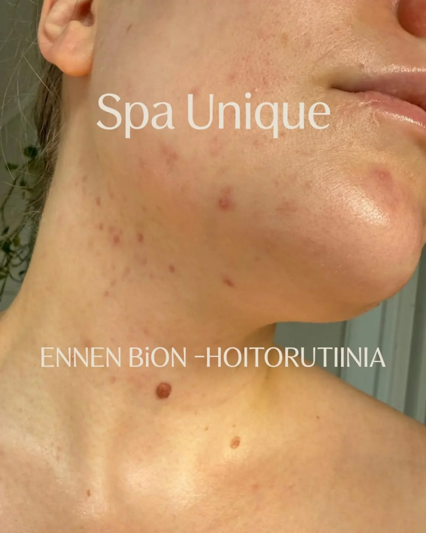 Saimme upean asiakaspalautteen 🥰🙏 

&quot;Hain maanantaina 25.8. teilt&auml; Acne control kitin sek&auml; Purifying mistin. Ja enp&auml; voi tarpeeksi teit&auml; kiitt&auml;&auml;!! Niin osaavaa ja ihanaa palvelua, ja kaiken kukkuraksi onpa olleet 