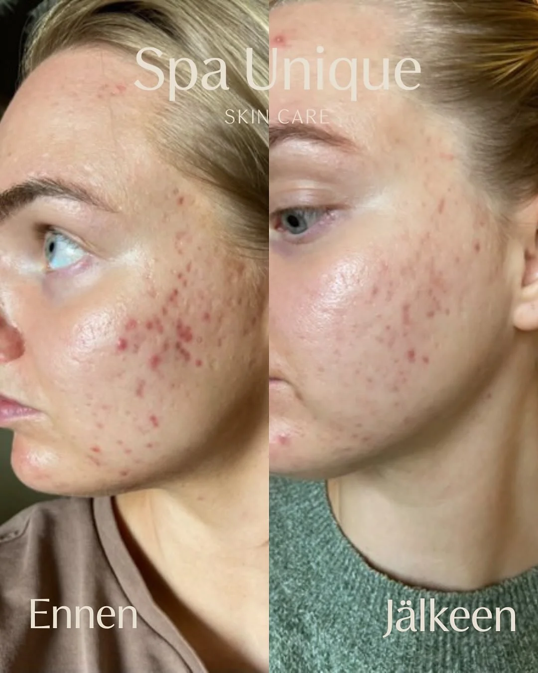 Tulokset ja asiakastyytyv&auml;isyys on t&auml;ss&auml; ty&ouml;ss&auml; se suola! On niin palkitsevaa saada kuulla miten olemme voineet auttaa asiakasta iho-ongelmissa, joiden kanssa on kamppailtu pitk&auml;&auml;n🧡
Tulehtunut akne saatiin kuriin n