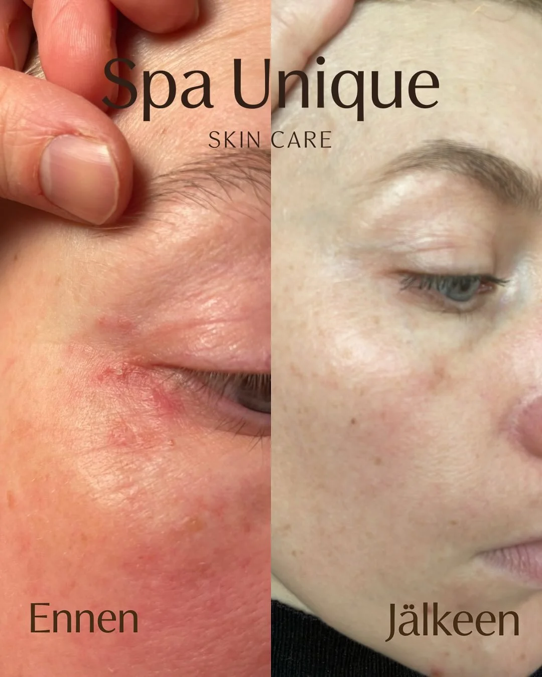 Perioraalidermatiitti (POD) on ihottumatila jota esiintyy yleisimmin suun, silmien ja nen&auml;n alueella. Oireita voivat olla kutina, kuivuus, punoitus ja hilseily. POD ihon hoidossa on t&auml;rke&auml;&auml; l&auml;hte&auml; hillitsem&auml;&auml;n 