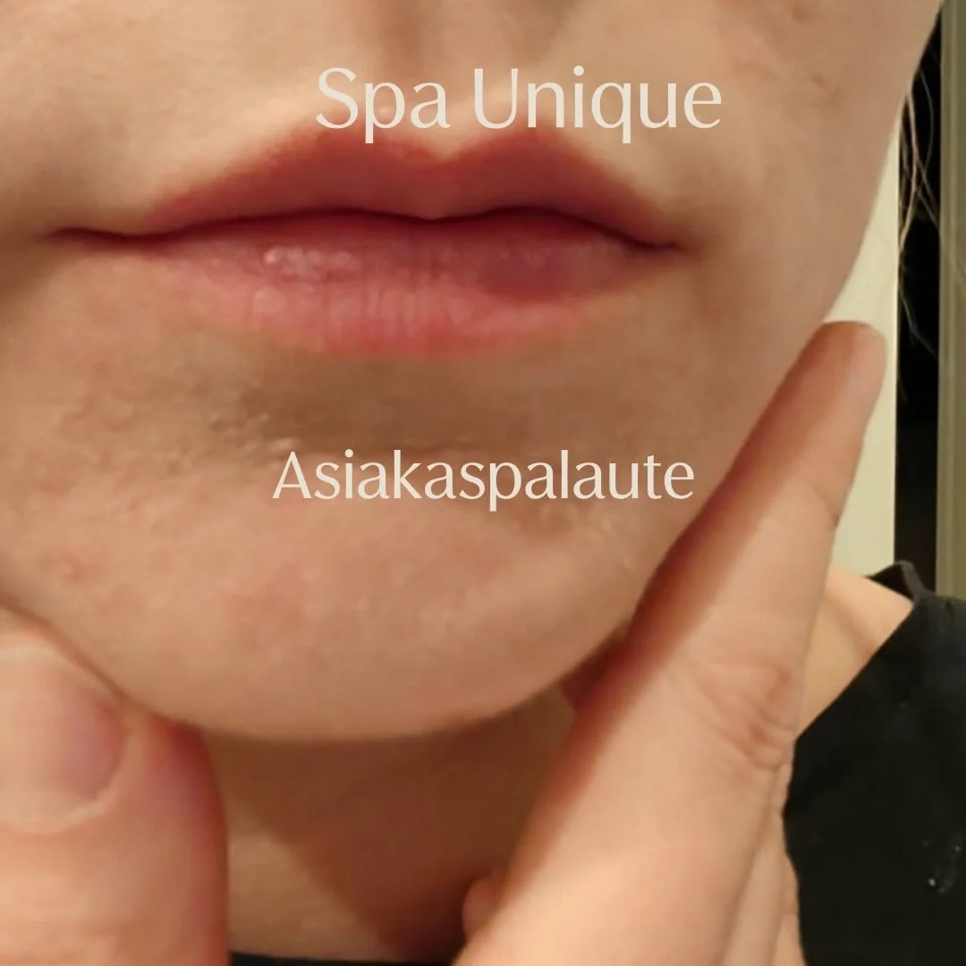 Asiakkaan palaute (POD) perioraalidermatiitin kotihoidosta. 🤎🫶💯✨

#acnespecialist #bionkosmetologi #spaunique_kuopio