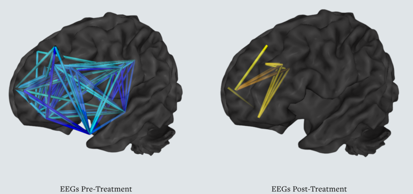 The Fuller Picture of CTE: Moving Beyond the Hit to Proactive Brain Healing