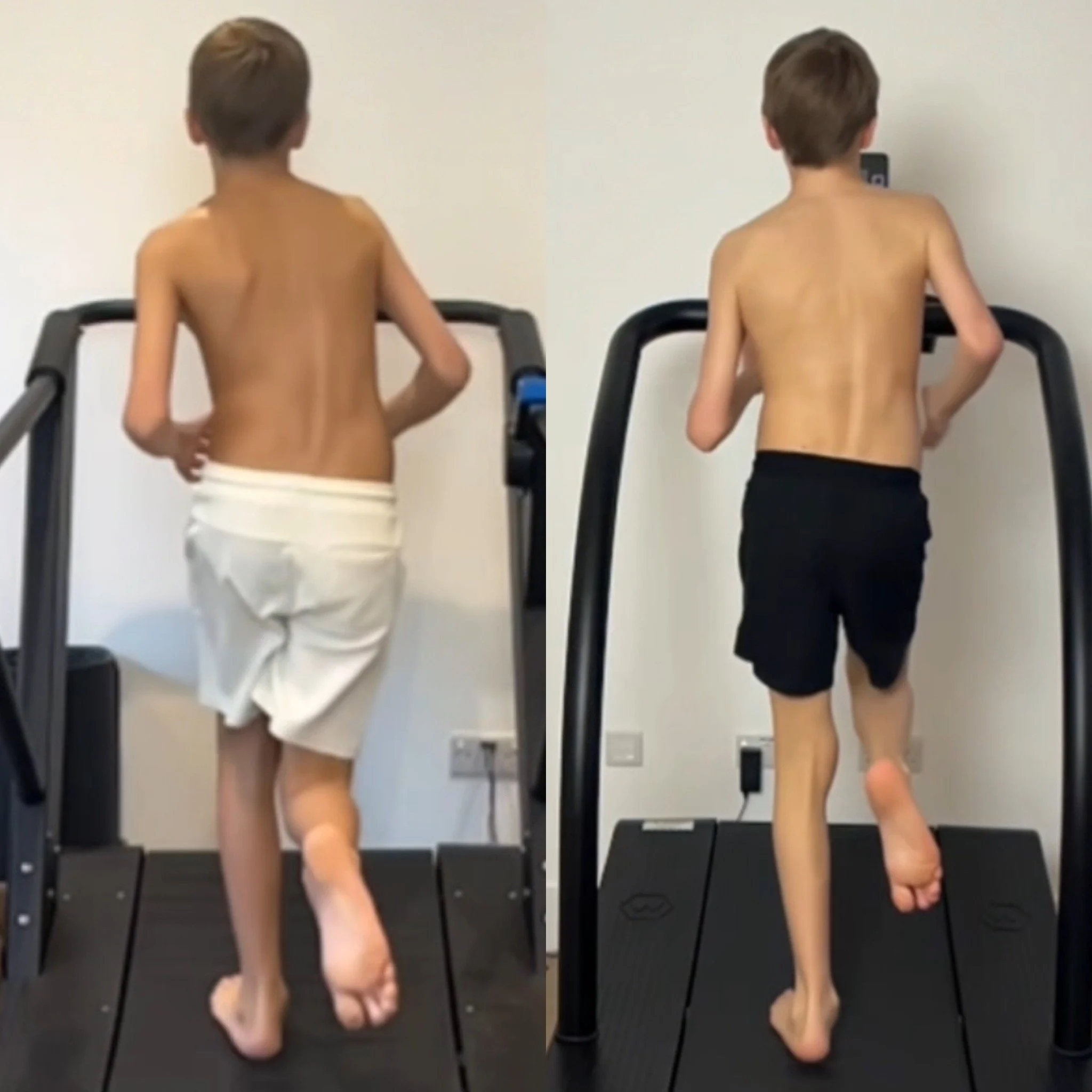 Zak, gait improvements

Before: September 2025 (age 12)
After: March 2026 (age 13)

7 months of FP training

Before:
- Unstable hips and lower back
- Scapula winging

After:
- Improved hip stability
- Improved scapula winging 