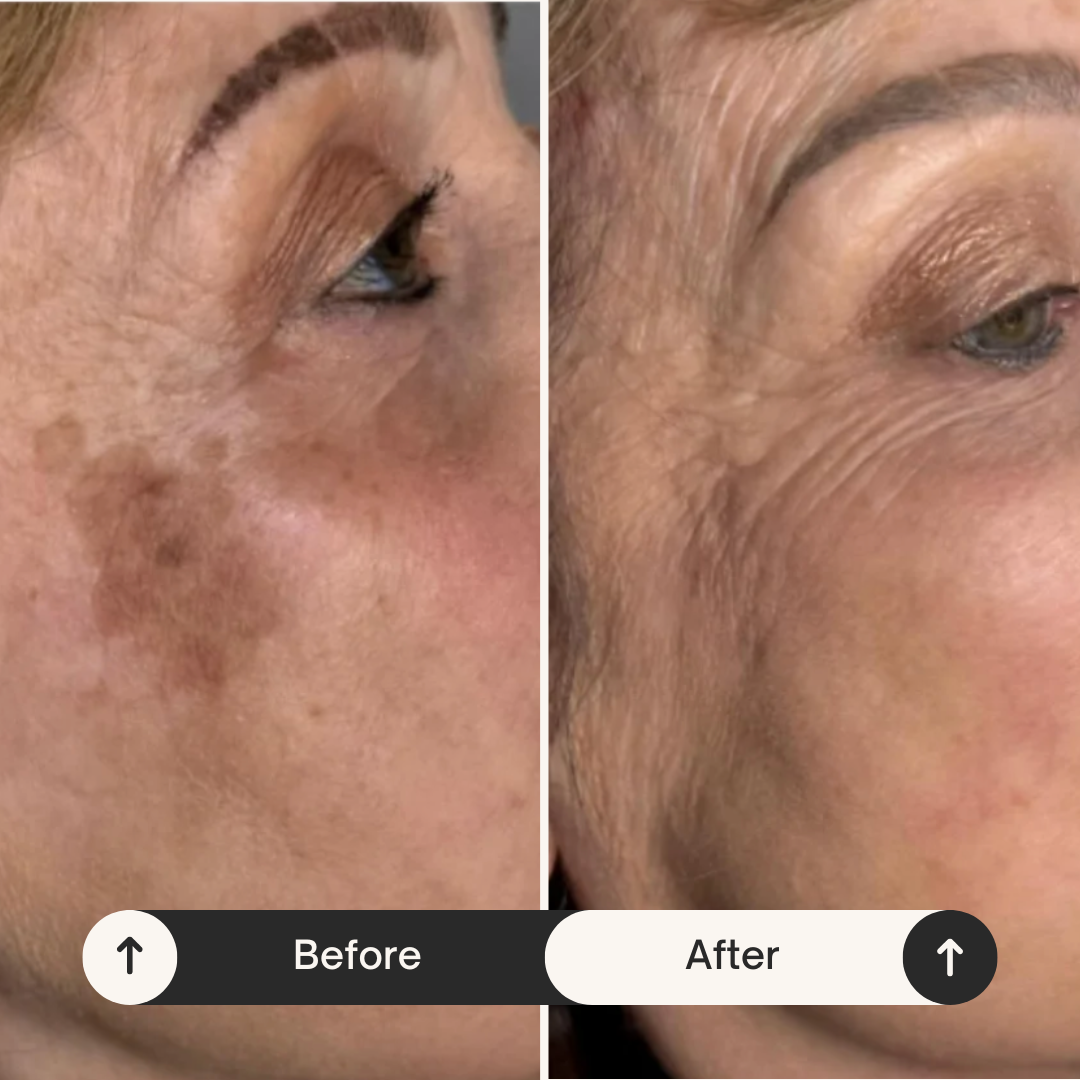 Side-by-side comparison of a woman's face before and after skin treatment, showing improvement in pigmentation and skin texture.