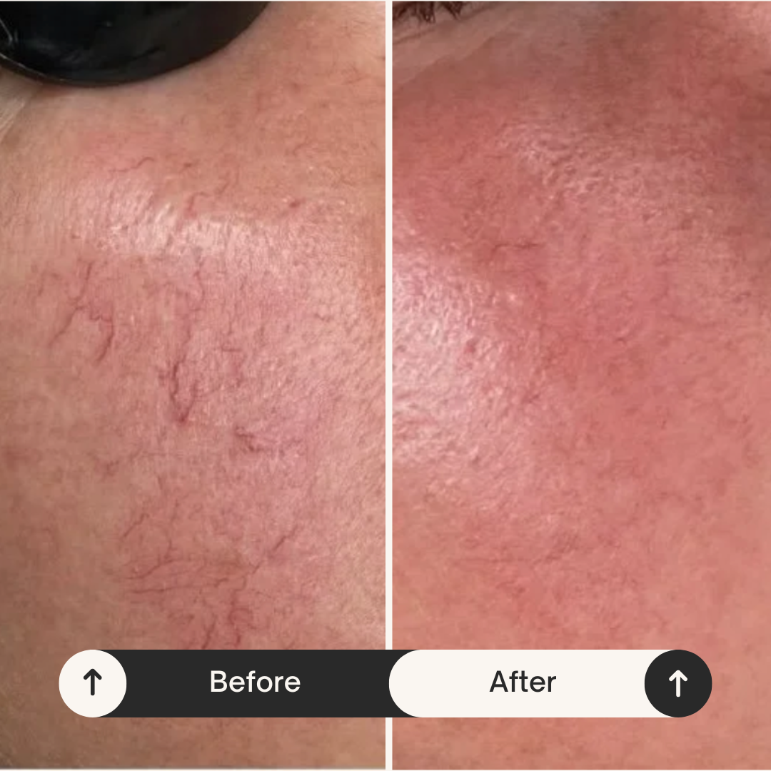 Close-up of facial skin showing a before-and-after comparison; the left side shows dry, cracked, and broken skin with visible redness, while the right side shows smoother, more hydrated skin with reduced redness.