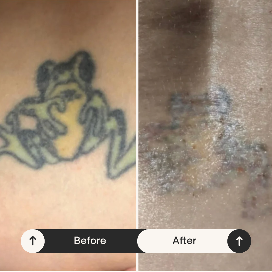 Comparison of a tattoo before and after removal, showing tattoo of a bear on the left and faded remnants on the right.