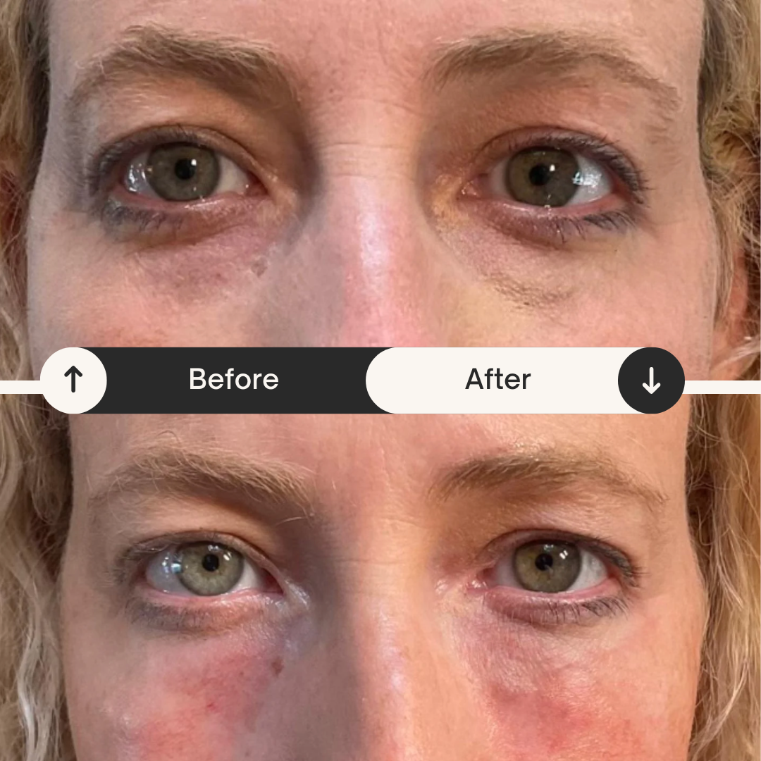 Comparison of a woman's eyes before and after skincare treatment, showing reduced dark circles and improved skin texture.