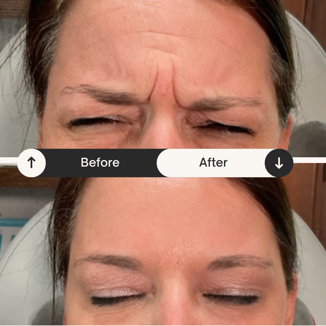 Side-by-side comparison of a woman's forehead: the top image shows deep wrinkles between the eyebrows, the bottom image shows smooth skin after treatment.