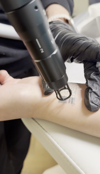 A person wearing black gloves performing a medical or cosmetic procedure on a patient's leg using a handheld device.