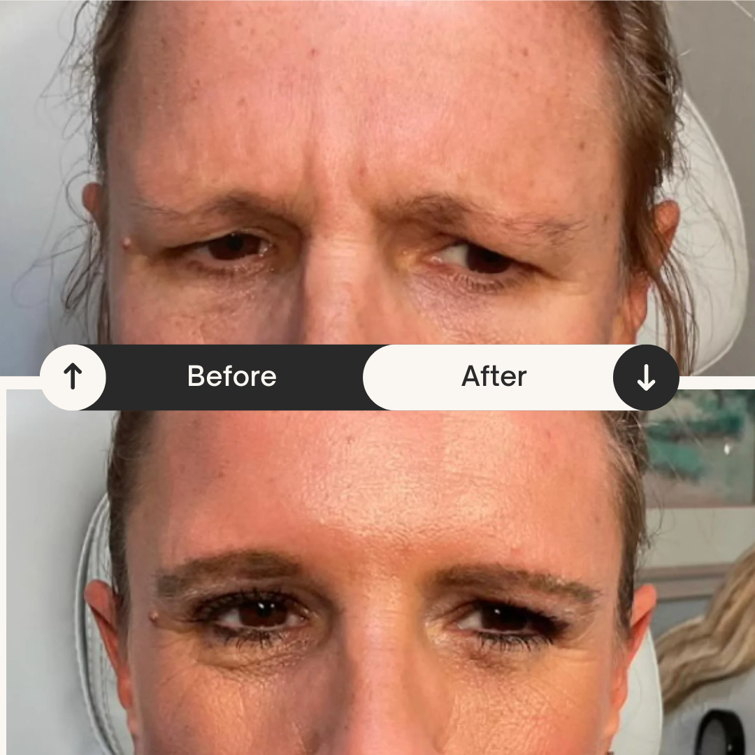 Comparison photo showing before and after results of a cosmetic or skincare treatment on a woman's face, highlighting clearer skin and reduced forehead wrinkles in the 'after' image.