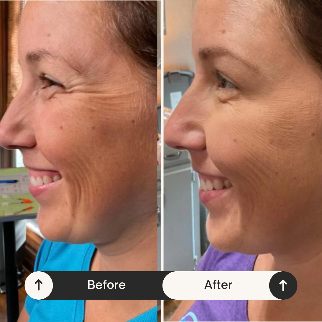 Side-by-side comparison of a woman's face before and after skincare treatment, showing reduced wrinkles and improved skin texture.
