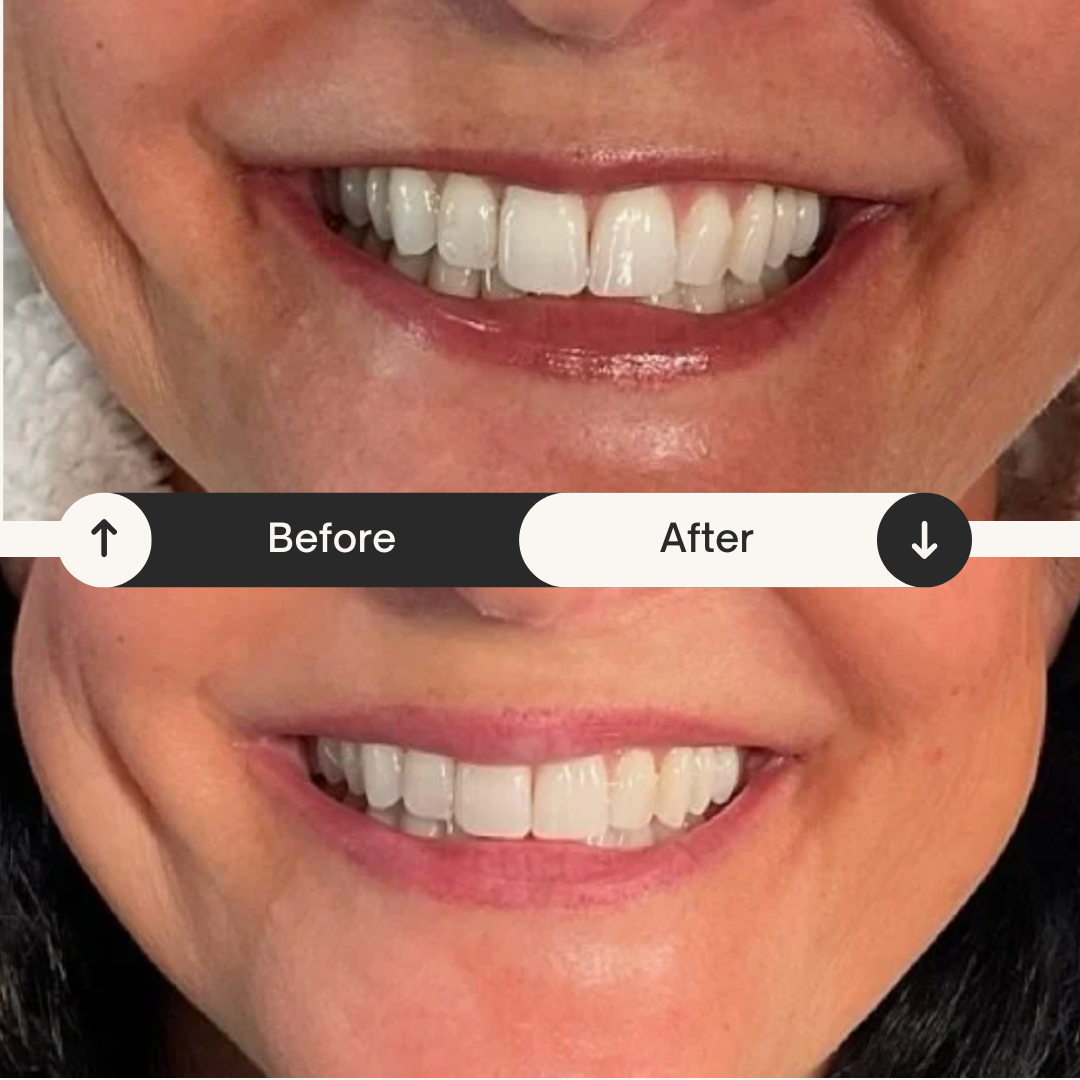 Close-up of a person's smile showing before and after teeth whitening, with the upper part showing yellowish teeth and the lower part showing whiter teeth.