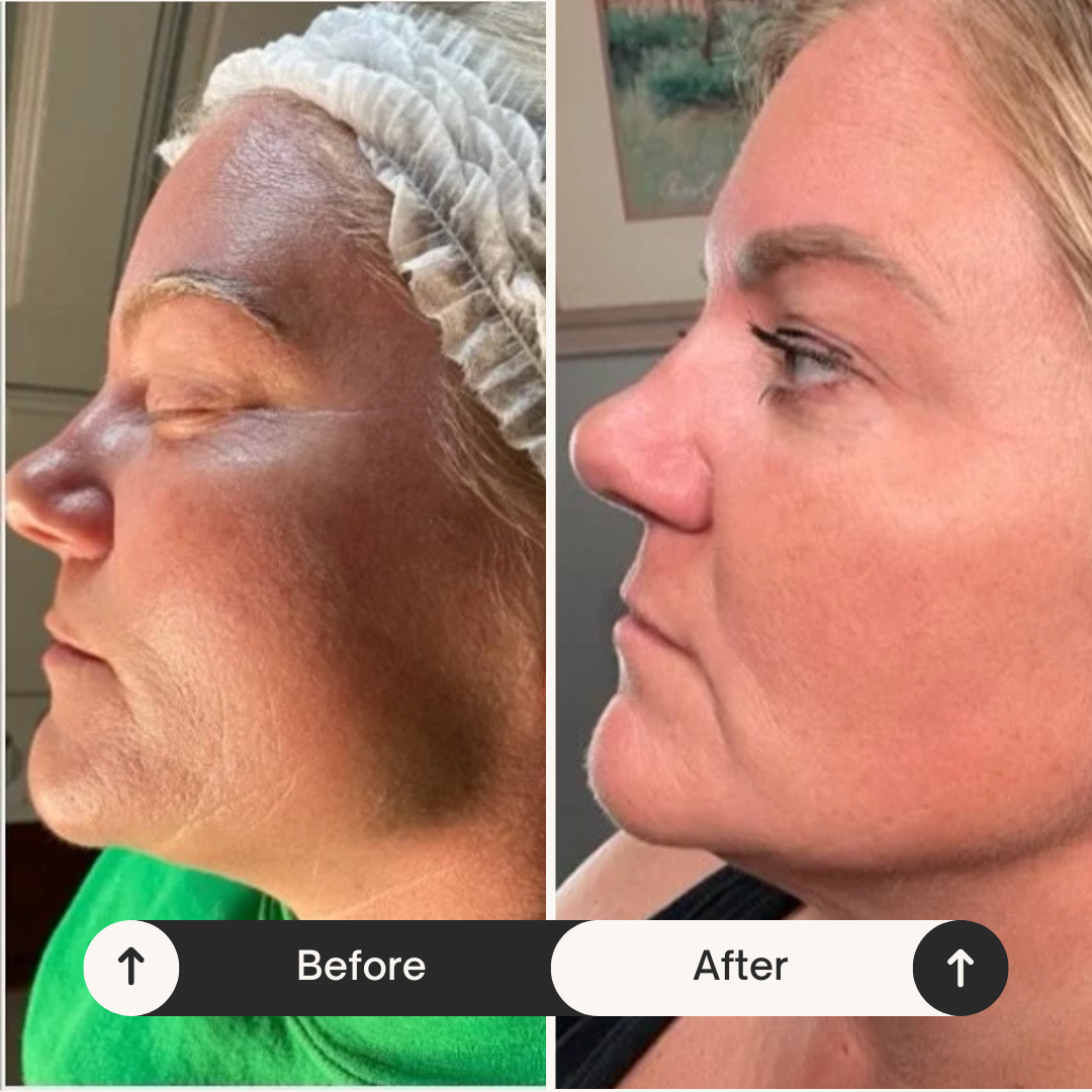 Side-by-side comparison photo showing a woman before and after a cosmetic procedure. The left image depicts her with visible skin discoloration and uneven tone, while the right image shows her with clearer, smoother skin.