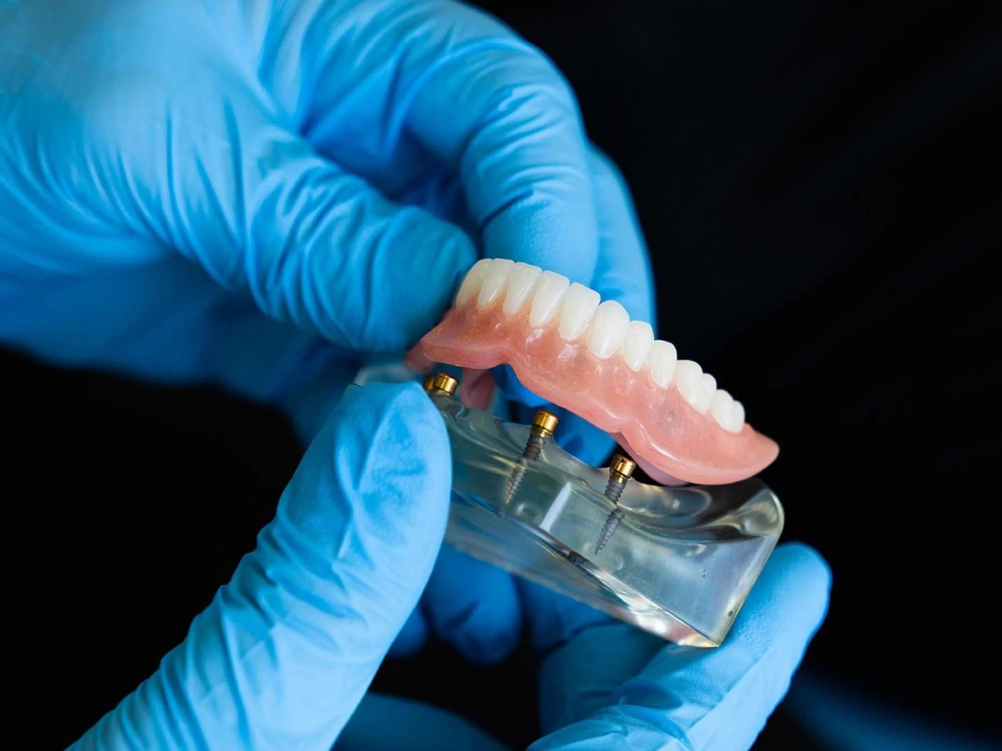 A dental professional wearing blue gloves inserting dental implants into a model of teeth.