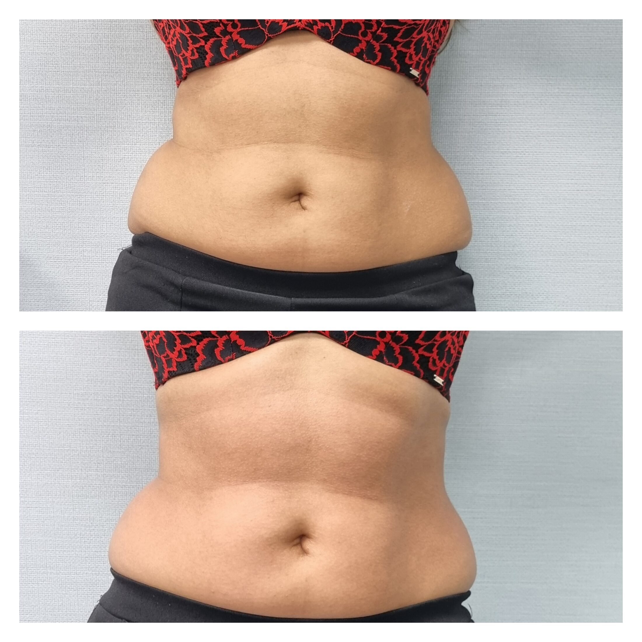 T-shape2-after-1-front-scaled.jpg