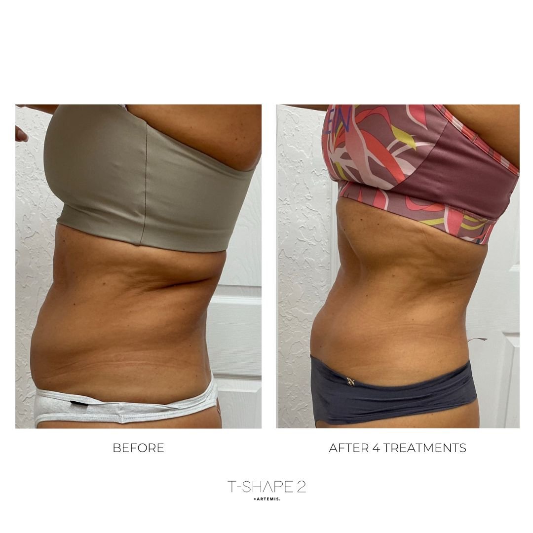 After-4-treatments-2.jpg