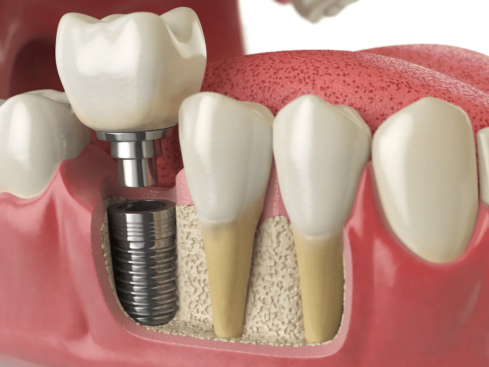 Dental Implants — Ingleside Family Dental