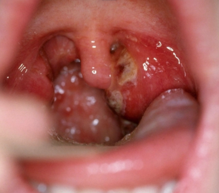 Strep Throat Natural Support