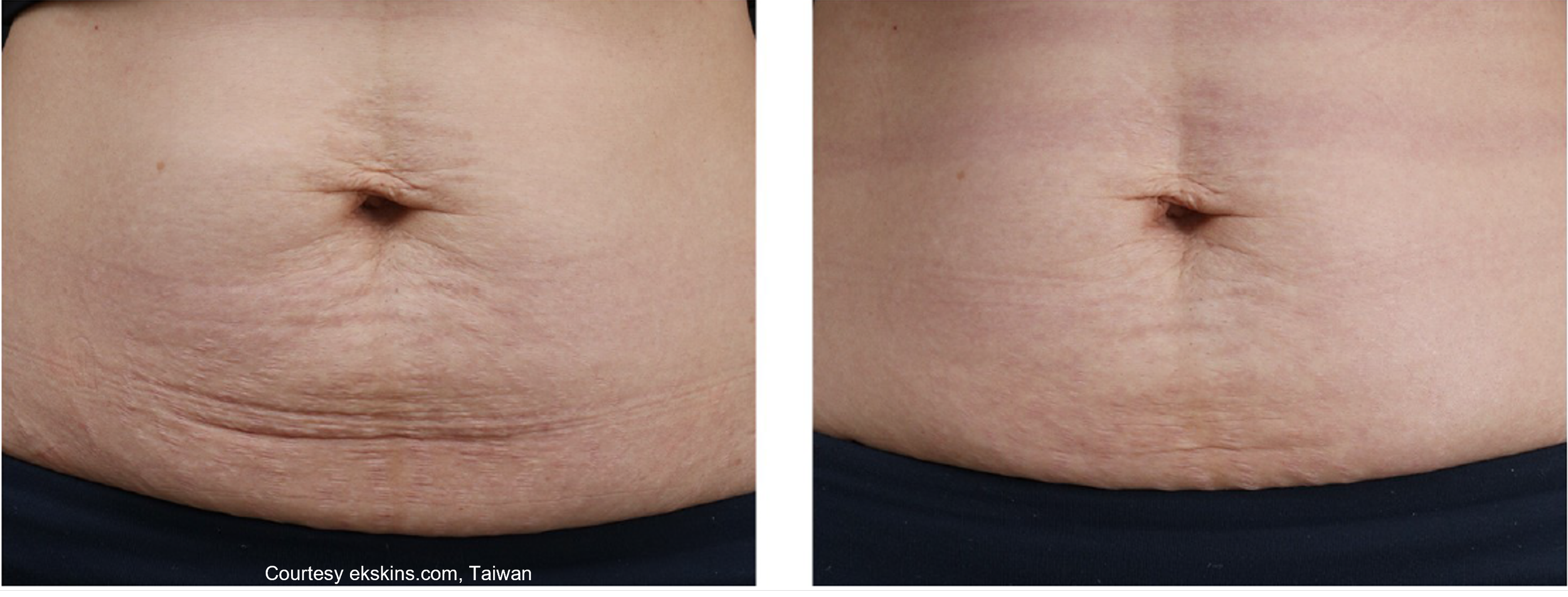 stretch marks crepey skin.png