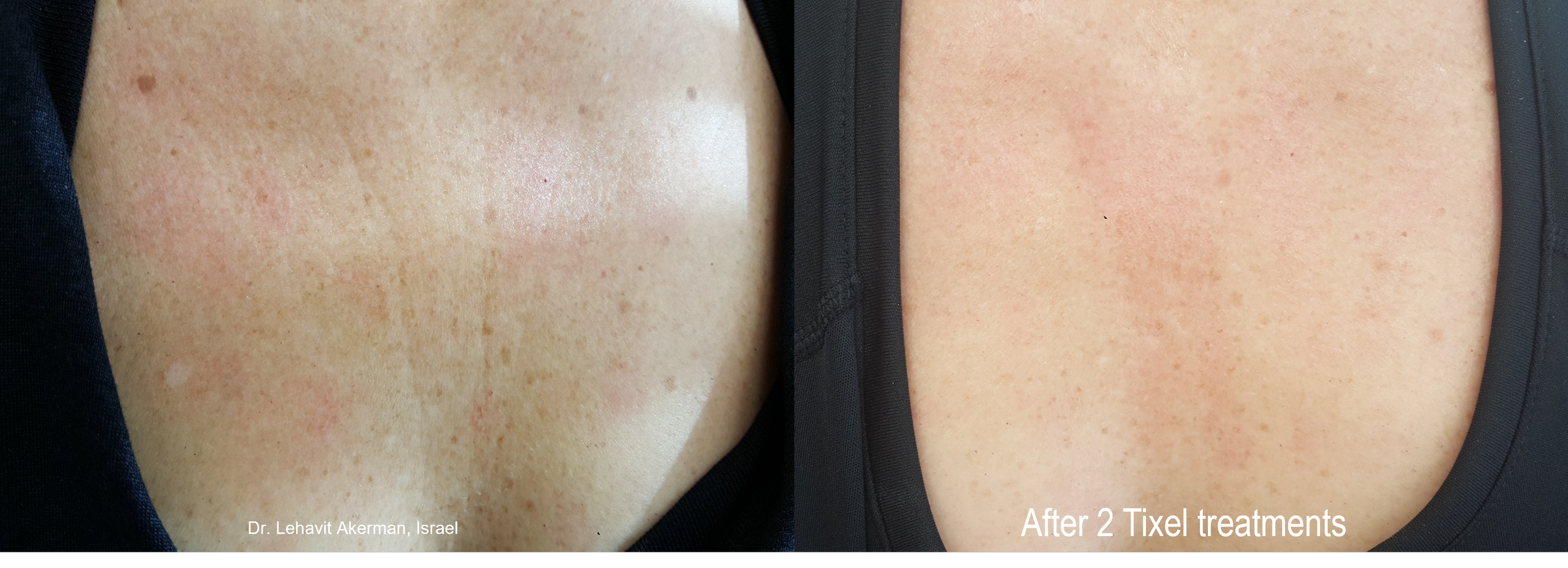 Tixel chest before and after.png