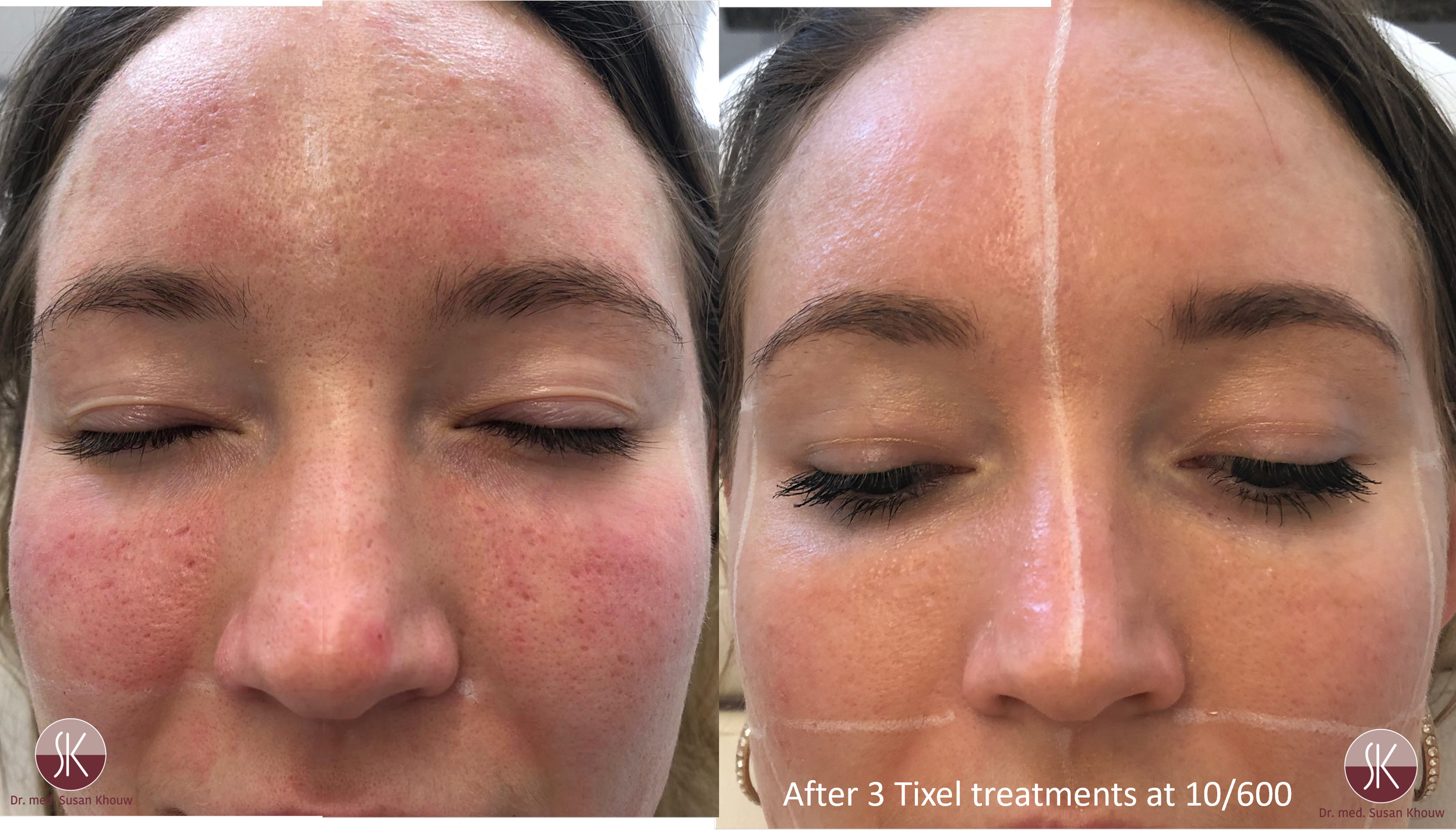 acne 2.png