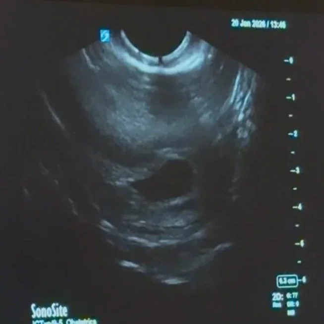 My Miscarriage as a Strong Black Woman