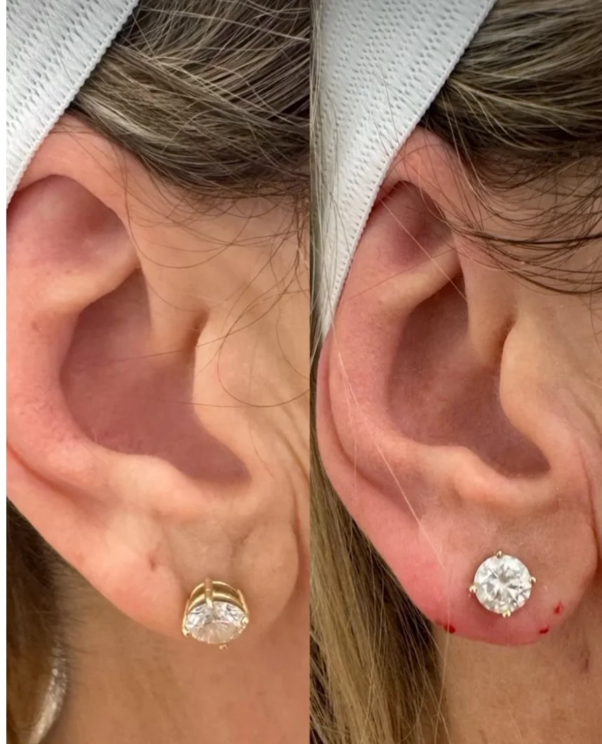 Ear lobe filler