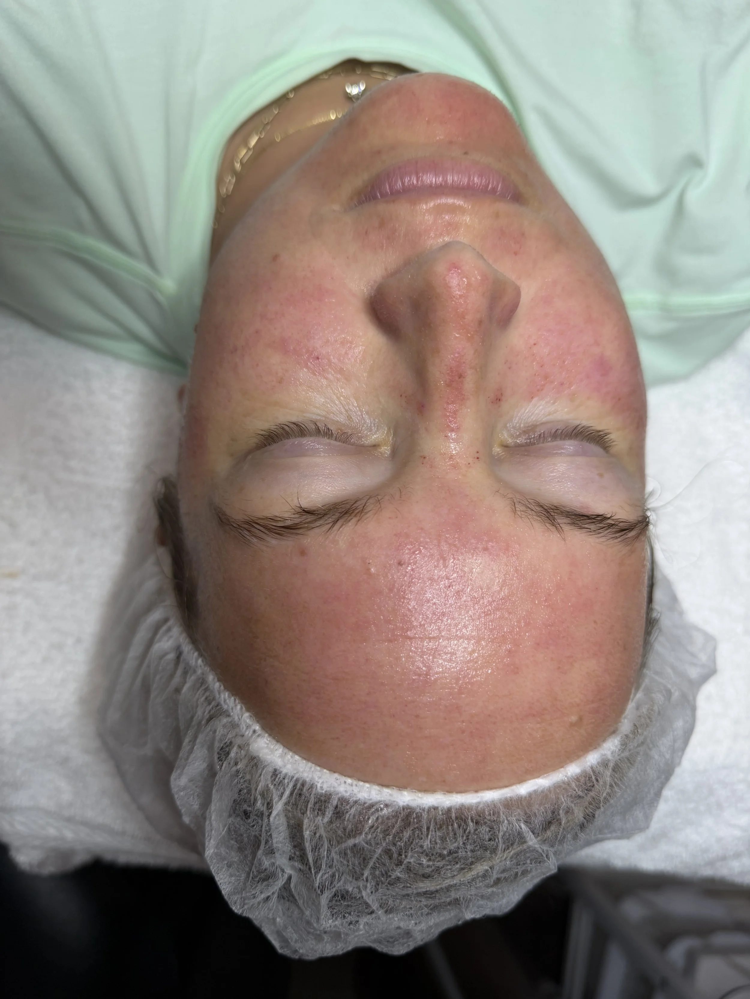 Microneedling with SkinPen