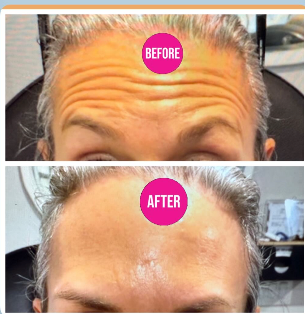 Botox