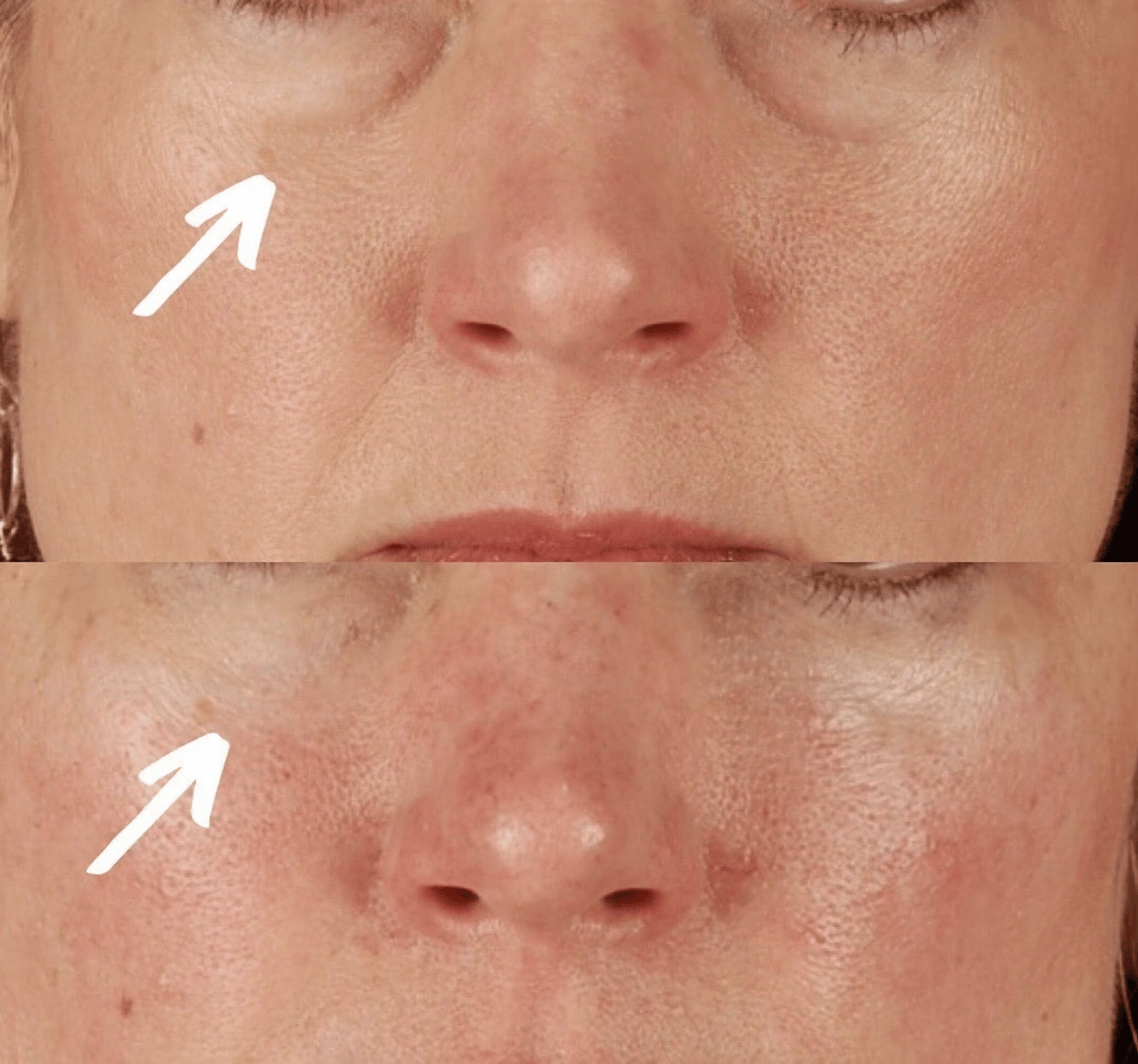 PRF facial injections