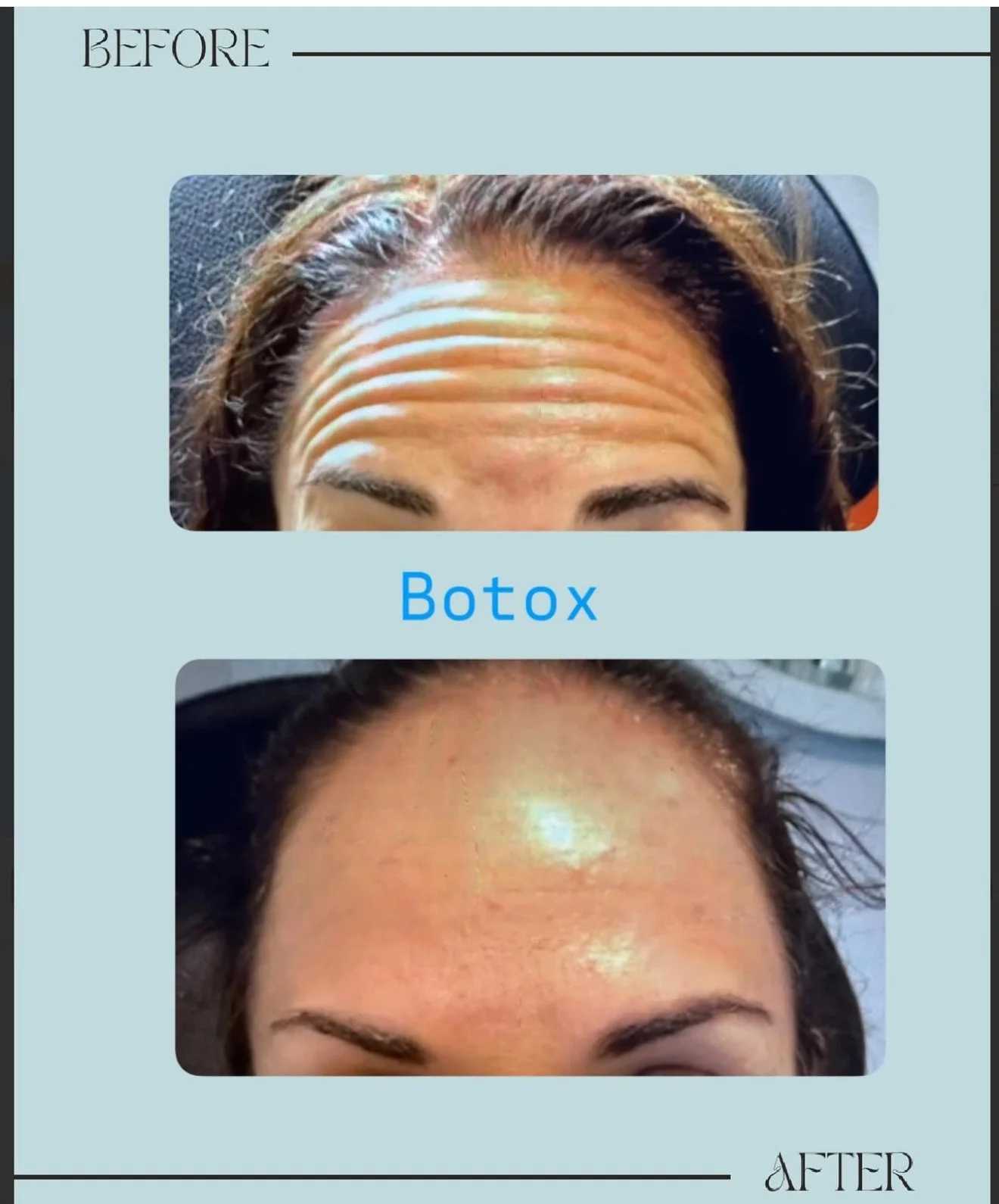 Botox