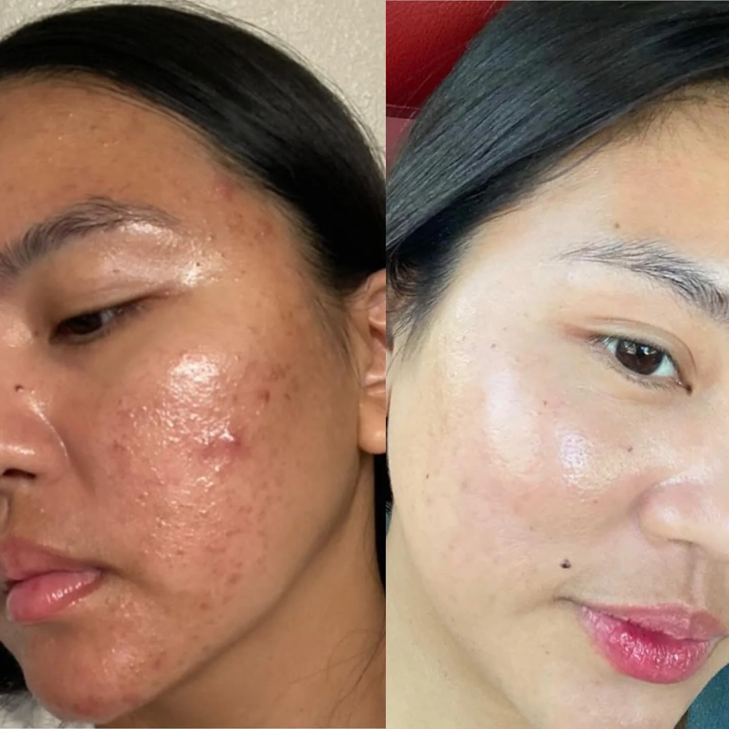 many before and afters &hellip; but this is the latest one that I can actually post 😍🫶🏽❤️ The purging process was 👺 but thanks for trusting the process.  Some of the results after a few facials + new regimen

- Actives from FR 
- moisturizer, cle