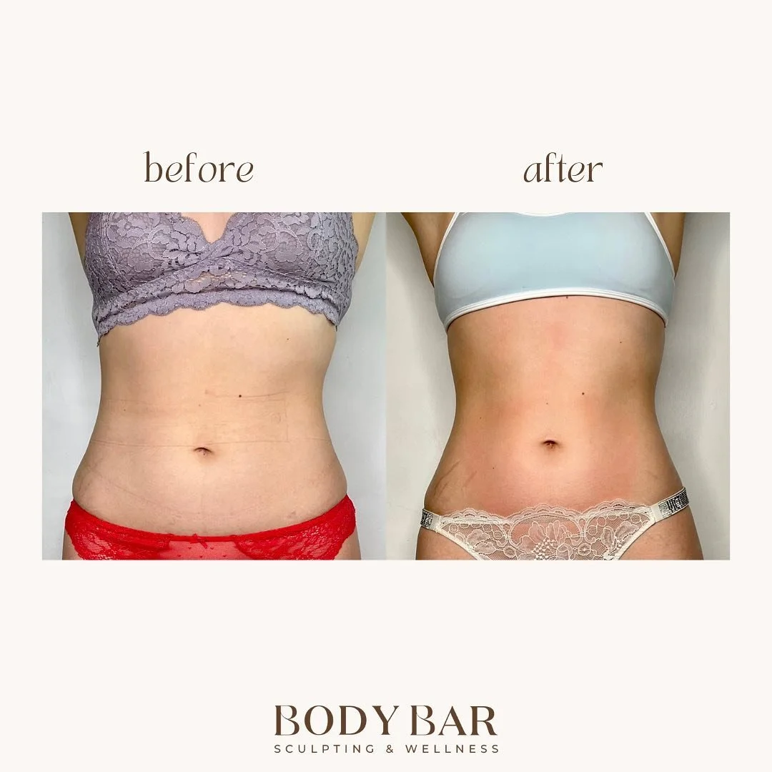We love hearing reviews from our clients👇🏽 &ldquo;Every session has been amazing, and the results keep getting better with each day. It makes you feel amazing and Elli makes you feel so welcomed and comfortable.&rdquo; 

Before &amp; Post 3 X sessi