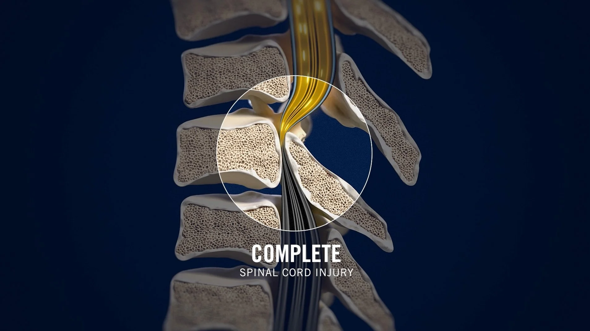 Explainer | Spinal Cord Injury